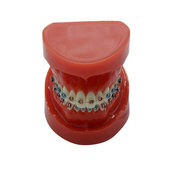 Modèle d'étude UM-B16 avec accolades fixes sur les dents (normal)