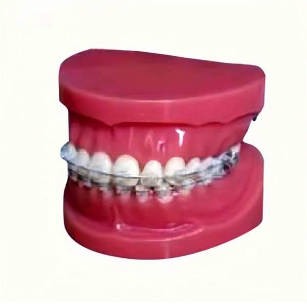 Modèle d'étude UM-B17 avec accolades fixes sur les dents (normal)