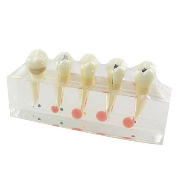 UM-L3A modèle clinique de la maladie dentaire et de la pulpe dentaire